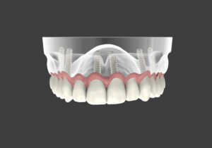 L'impianto dentale fa male? Ecco cosa sapere