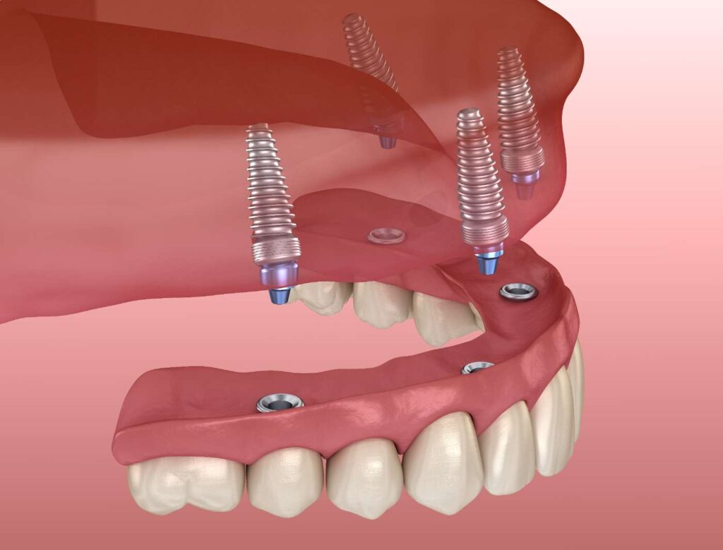 Impianti dentali: fanno male?